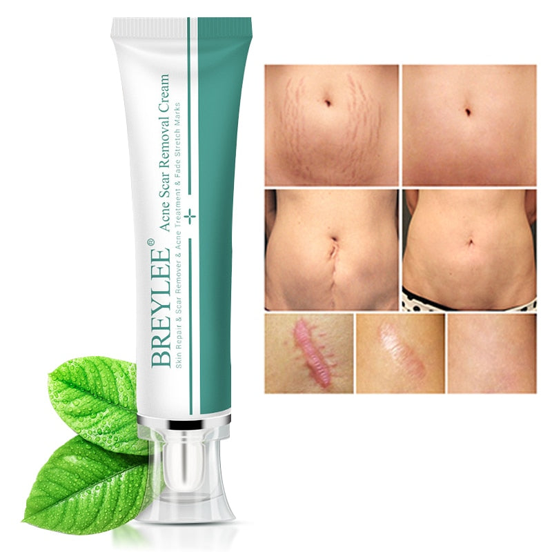 Removal Scar Cream Face Pimples Scar Stretch Marks Removal Acne Treatment Whitening Moisturizing Cream Skin Care